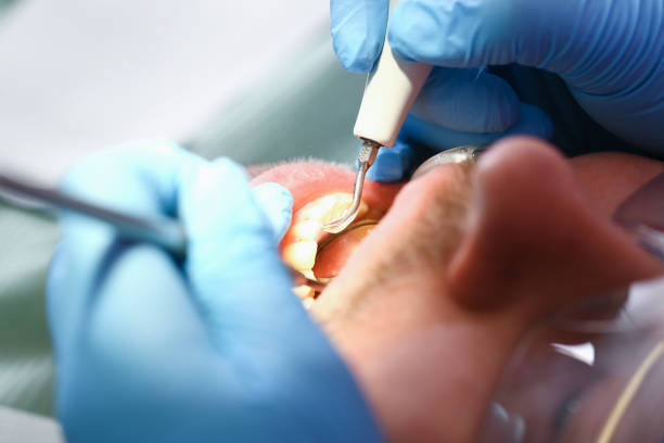 Best Emergency Dental Care for Broken or Chipped Teeth in Lambertville, NJ